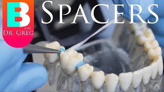 BRACES EXPLAINED Spacers [upl. by Anwahsed]