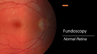 Healthy Retina Fundoscopy [upl. by Yhcir]