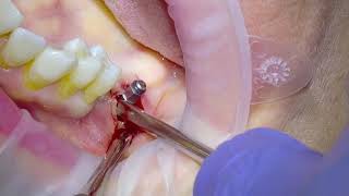 Removal of an infected Dental Implant [upl. by Naenaj]