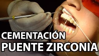 Cementación Puente Zirconia 6 Unidades👅Parte2 [upl. by Ettelohcin]