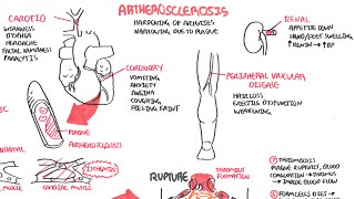 Atherosclerosis  Pathophysiology [upl. by Ellehcor]