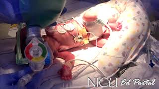 Surfactant administration NICU [upl. by Debo]