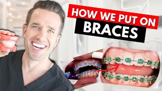 How Braces are Put On  Part IV Dr Nate [upl. by Audrey142]