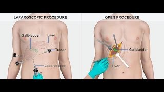 How to scan the gallbladder using portable ultrasound [upl. by Bor]