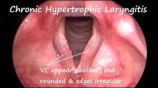 Laryngology  Chronic Hypertrophic Laryngitis [upl. by Tatiana]