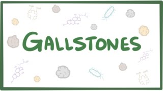 Gallstones cholelithiasis [upl. by Lisette]