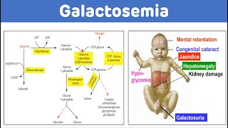 Galactosemia And Galactose Metabolism  Galactosemia Biochemistry [upl. by Trini]