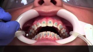 Getting Braces  How [upl. by Stevy]