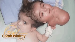 The 2Headed Baby Miracle  The Oprah Winfrey Show  Oprah Winfrey Network [upl. by Betthezel64]