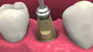 Restoring BioHorizons Dental Implants 2011 [upl. by Casper]