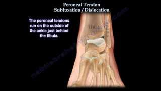 Peroneal Tendon Subluxation  Dislocation  Everything You Need To Know  Dr Nabil Ebraheim [upl. by Monson752]