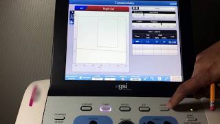 Eustachian Tube Function ETF Test for Perforated [upl. by Rramal]