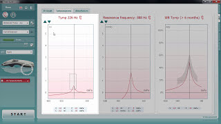 Wideband Tympanometry WBT Tympanograms Tab [upl. by Goodrich]