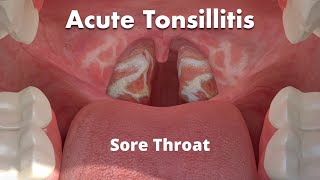 Antibiotic Awareness Sore Throat or Pharyngitis [upl. by Llednav775]