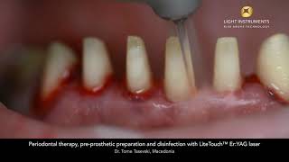 Periodontal therapy preprosthetic preparation and disinfection with LiteTouch™ ErYAG laser [upl. by Craw]