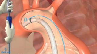 NERVE INJURY IN THE UPPER EXTREMITY Everything You Need To Know  Dr Nabil Ebraheim [upl. by Idzik]