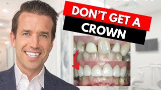 Watch this before getting a Dental Crown [upl. by Doreen322]