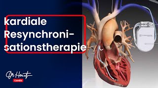 Kardiale Resynchronisationstherapie CRT  einfach erklärt  DrHeart [upl. by Enelcaj71]