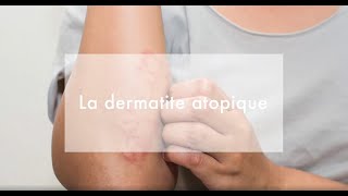 Mieux comprendre leczéma atopique [upl. by Mimajneb]