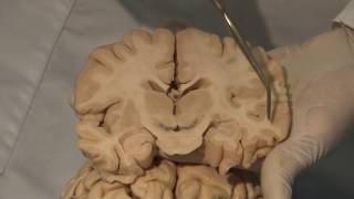 Cortical Localization Neuroanatomy Video Lab  Brain Dissections [upl. by Archangel]