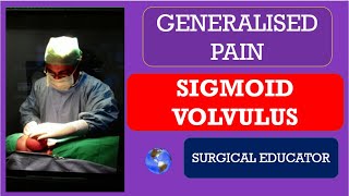 SIGMOID VOLVULUS How To DIAGNOSE amp TREAT Generalised Abdominal Pain [upl. by Ogata719]