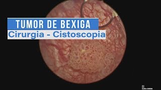 Tumor de Bexiga  Cirurgia  Cistoscopia [upl. by Daney803]