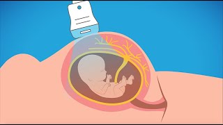 ACOG Explains Prenatal Genetic Testing [upl. by Eilyw]