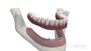 Prothèse complète sur implants  Centres dentaires Lapointe [upl. by Leiuqese83]