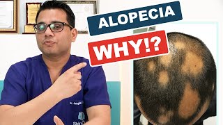 What is Alopecia areata  Causes Diagnosis amp Hair Regrowth Treatments skinqure in Hindi [upl. by Azirb443]