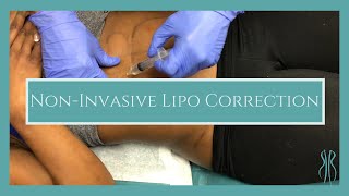 NonInvasive Lipo Correction [upl. by Ennayd]