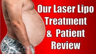 Lipo Laser ilipo Treatment amp Review From a Patient [upl. by Rattray]