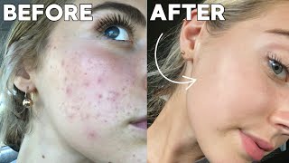 How I Cleared My Skin In 8 Weeks naturally [upl. by Akcirehs]