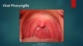 Viral Pharyngitis [upl. by Grindlay]