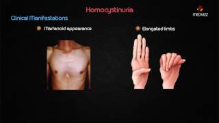 Homocystinuria  Usmle step 1 biochemistry Webinar based lecture [upl. by Christyna957]