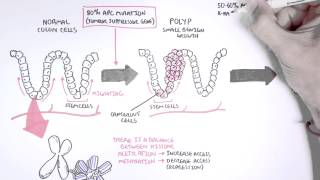 Colon Cancer Carcinogensis [upl. by Clayton326]