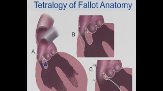 Jasmine S  Heart Surgery Saves MicroPreemie with Tetralogy of Fallot [upl. by Nauqe291]