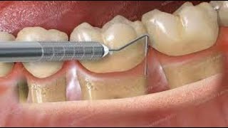 APD 17 PERIODONTOGRAMA  COMO PREENCHER [upl. by Lai]