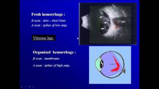 Large Eye Floaters Explained  Posterior Vitreous Detachment PVD [upl. by Hsinam171]