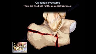 Fracture Healing  Everything You Need To Know  Dr Nabil Ebraheim [upl. by Seline]