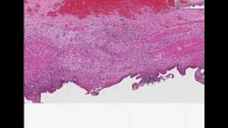 Histopathology GallbladderChronic cholecystitis [upl. by Honebein325]