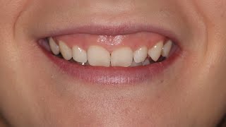 Sonrisa Gingival y Sobremordida Extrema con Minitornillo Extreme Gummy Smile and Overbite Tads [upl. by Buford]