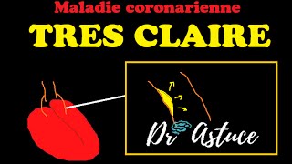 Maladie Coronaire Expliquée Très Clairement  LECG 34  Dr Astuce [upl. by Eatnuhs684]