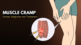 Muscle cramp Causes Signs and Symptoms Diagnosis and Treatment [upl. by Nelle91]