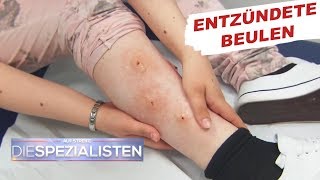 Beulen an den Beinen Parasitenbefall  Auf Streife  Die Spezialisten  SAT1 TV [upl. by Itsym]