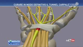 Il mio medico  Tunnel Carpale come curarlo [upl. by Park999]