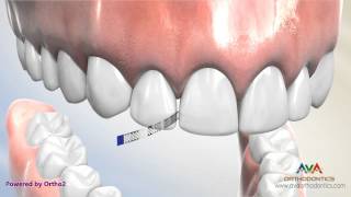 Interproximal Reduction or IPR  Polishing Strip [upl. by Fredenburg]