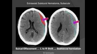 Subdural Hematoma SDH [upl. by Ahsena]