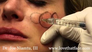 Juverderm Voluma 5 Minute Cheeks by Dr Joe Niamtu III [upl. by Alena]