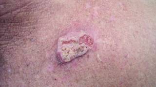 How dangerous is Squamous Cell Carcinoma [upl. by Cammy]