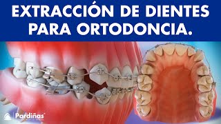 Extracción de dientes en ortodoncia © [upl. by Kappel]